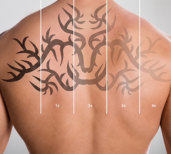 tatoeageverwijdering in 4 stappen